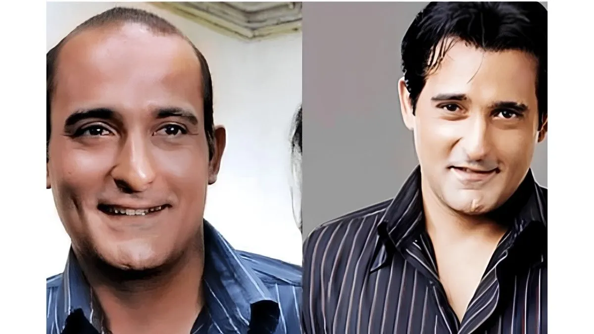 Bollywood’s Secret Hair Fix? Why Hair Patches Are the New Confidence Trend